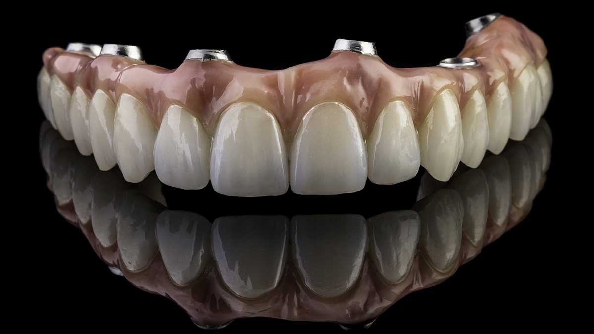 Digital dental prosthesis